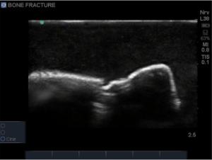 Bone fracture µltrasound training block model with crepitus fractures