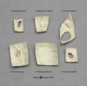 BoneClones® Skull Trauma Set of Six Fragments