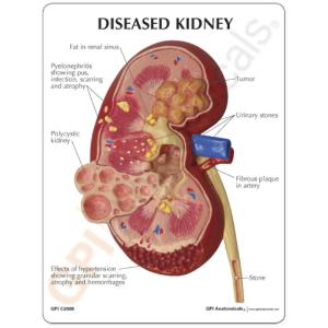 GPI Anatomicals® Kidney Pathology Model