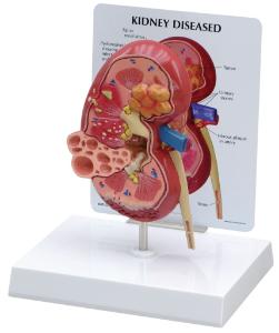 GPI Anatomicals® Kidney Pathology Model